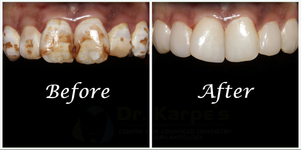 Correction Of Stained Teeth With Composite
